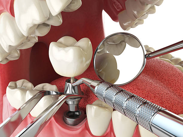 Best Emergency Dentist for Lost Fillings or Crowns in Hunter, TN